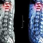 compress spinal cord